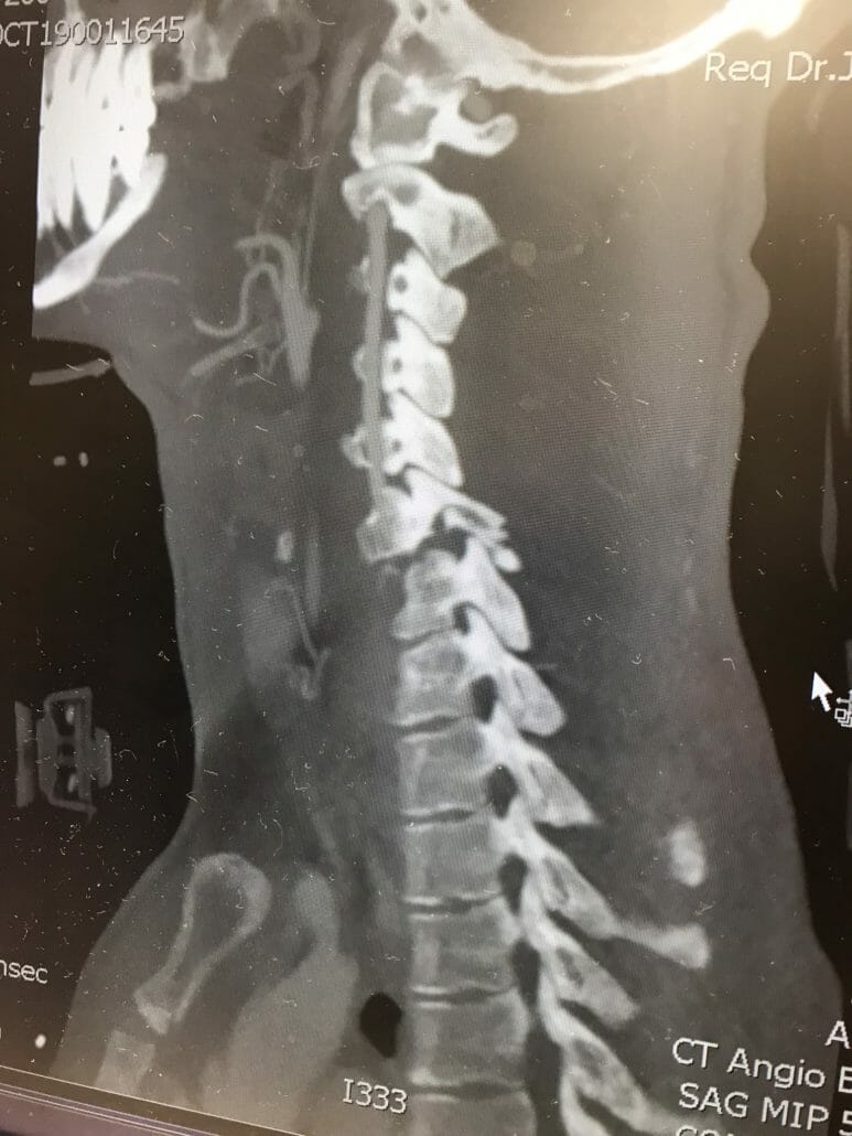 Blake Savage after falling in a wheelchair 28 IMG 0005 1