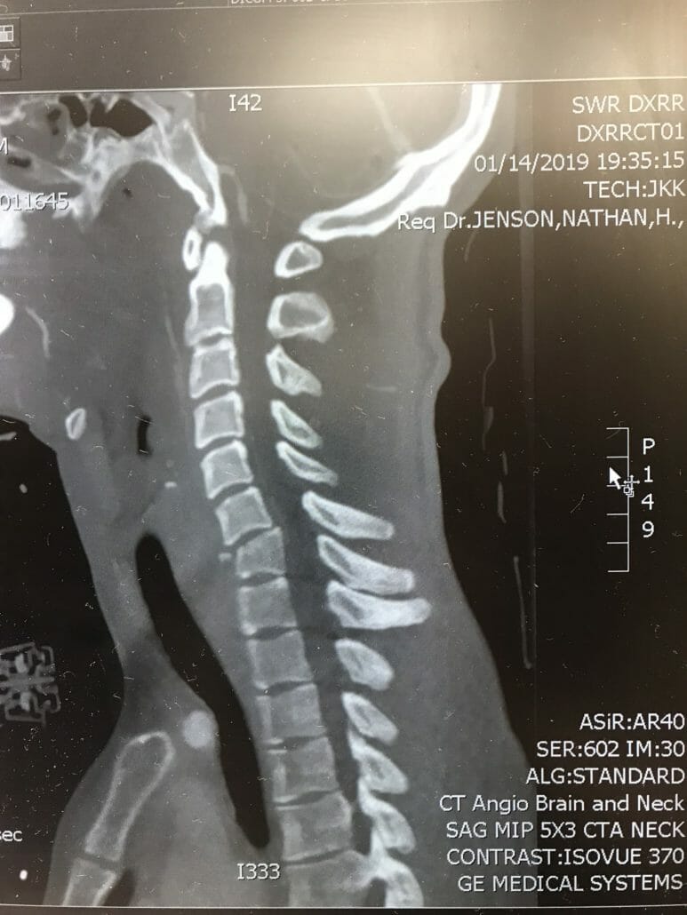 Blake Savage after falling in a wheelchair 30 IMG 0008